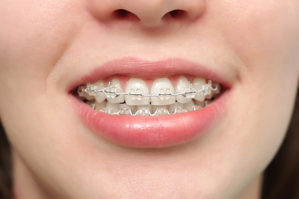 Why Choose Ceramic Braces? Benefits And Considerations