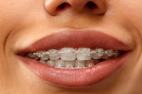 How To Care For Ceramic Braces